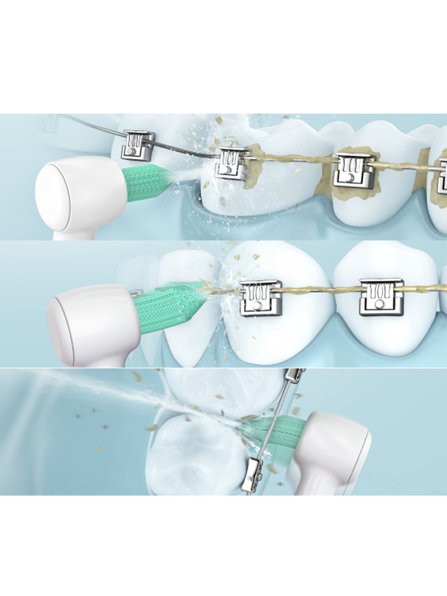 Orthodontic Nozzle WEW0984W303 for Panasonic Irrigators