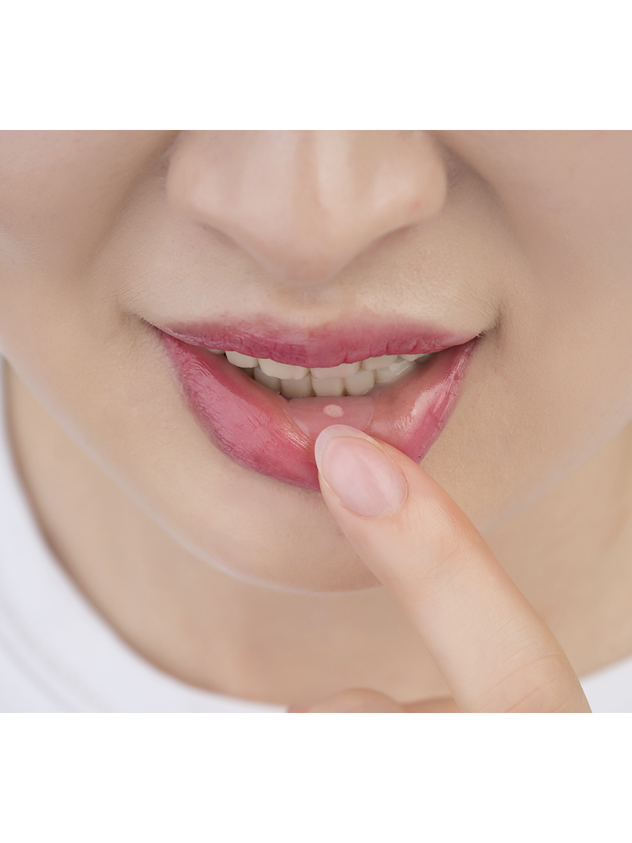 Curatick Healing Patch for Mouth Sores, 2 pcs.