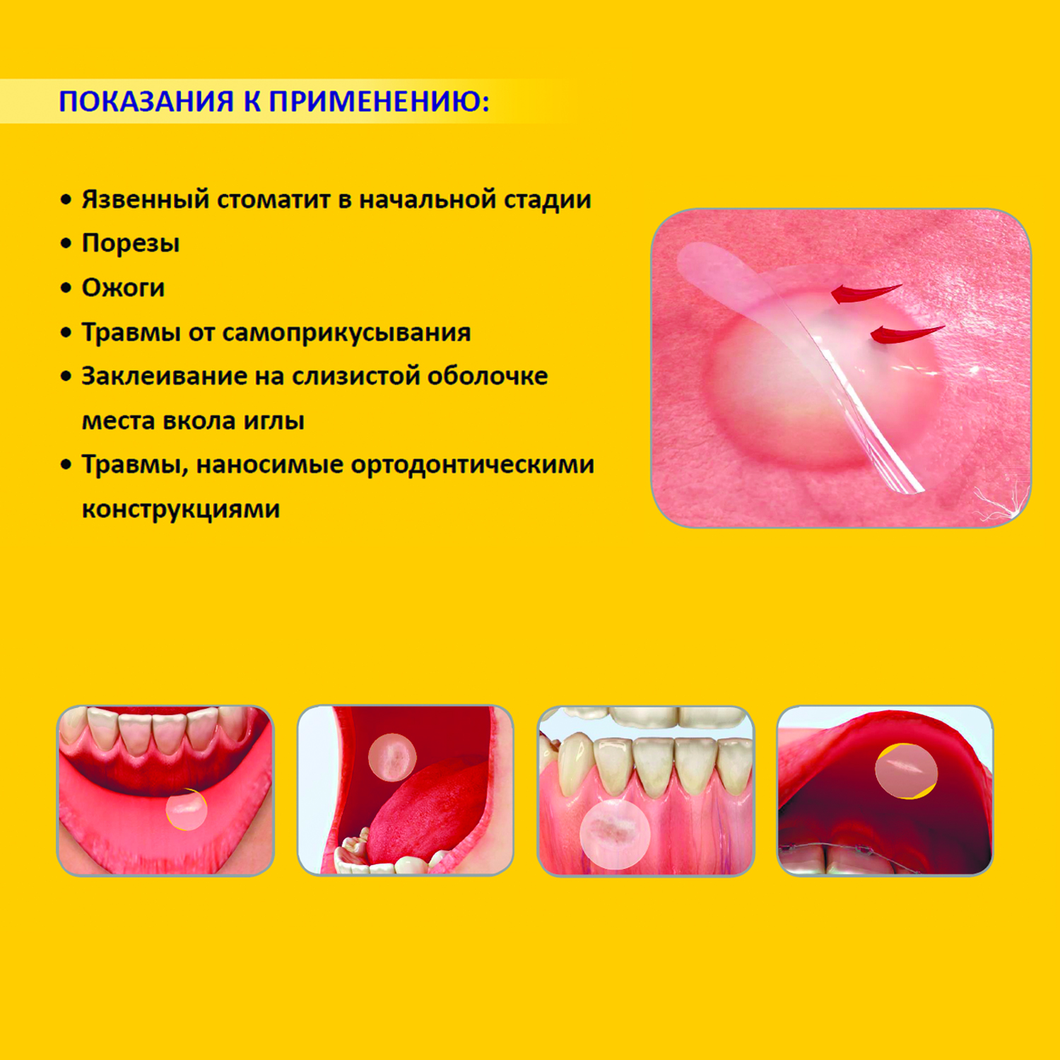 Curatick Healing Patch for Mouth Sores, 2 pcs.