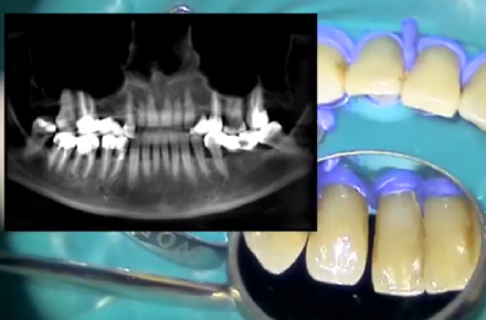 Шинирование при пародонтите при помощи Ribbond (видео) Шинирование при пародонтите при помощи Ribbond (видео)